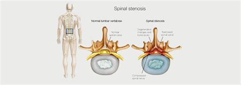 LUMBAR RADICULOPATHY - MOTUS Physical Therapy