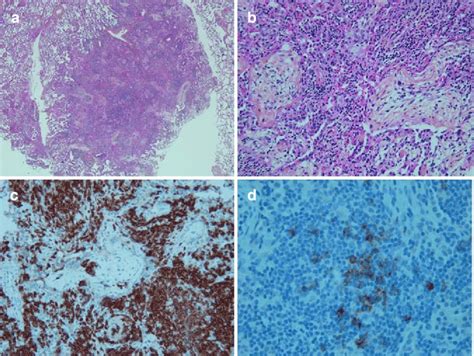 Open Lung Biopsy Cop Low Power A And High Power View B Of