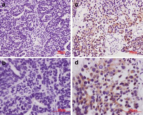 Immunohistochemical Staining Of HCMV In Metastatic Carcinoma HCMV