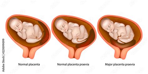 Different Placental Locations During Pregnancy Major Placenta Previa