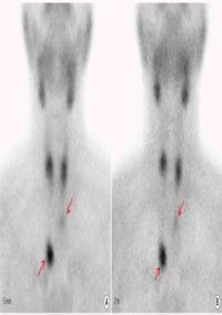 Thyroid Uptake And Scan St Elizabeth S Medical Center Steward