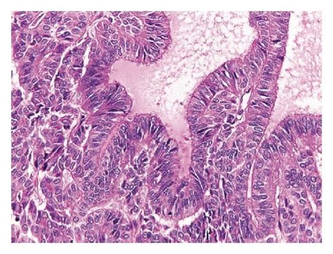 A Significant Histological Appearance Of The Ovarian Tumor A And Download Scientific