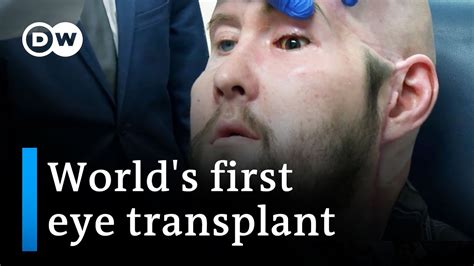 Surgeons perform world's first human eye transplant | DW News - The Global Herald