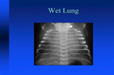 Wet Lung