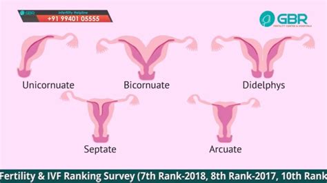Unicornuate Uterus Pregnancy Success