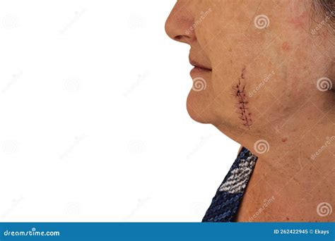 Stitches On Side Of Face From A Mole Cut Out Stock Image Image Of