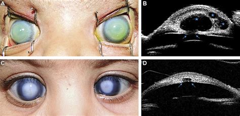 Corneal Remodeling In Peters Anomaly Ophthalmology