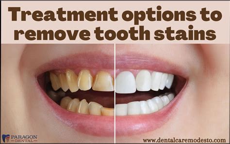 7 Treatment Options to Erase Tooth Stains - Paragon Dental