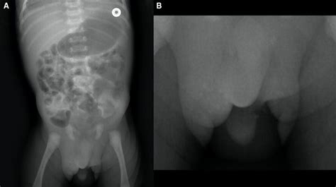 Scrotal Meconium Pseudocysts Meconium Periorchitis As A Rare Cause Of