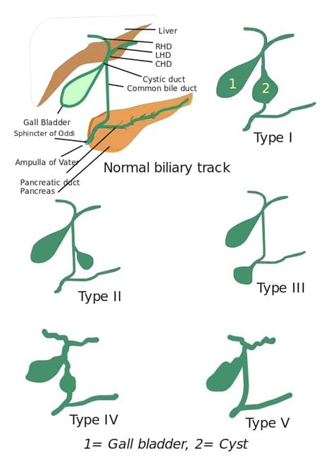 Choledochal Cyst And Anomalous Pancreaticobiliary Junction Radiology Features Radiogyan