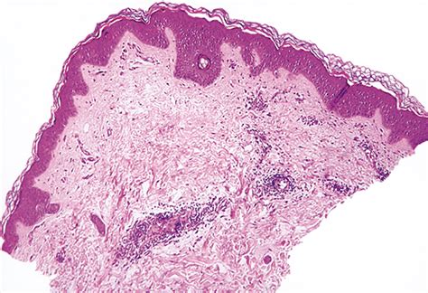 Pruritic Erythematous Macules In A 72 Year Old Woman—quiz Case Dermatology Jama Dermatology