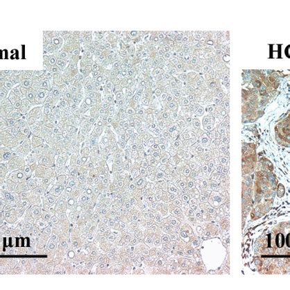 HIF 1 Protein Is Highly Expressed In Human HCC Tissues A Western