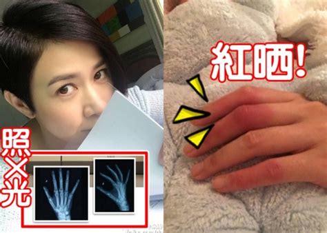 Tvb Entertainment News Charmaine Sheh Has Swollen Hands After Filming