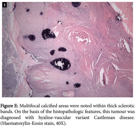 Chemotherapy Multifocal Calcified Areas