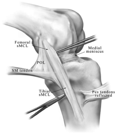 The Anatomy Of The Medial Patellofemoral Ligament