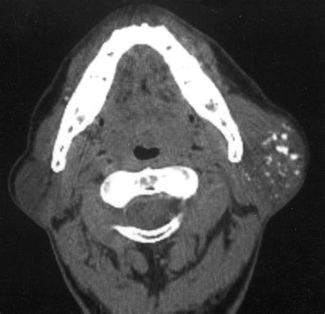 Long Standing Mucosa Associated Lymphoid Tissue Lymphoma Of The Parotid