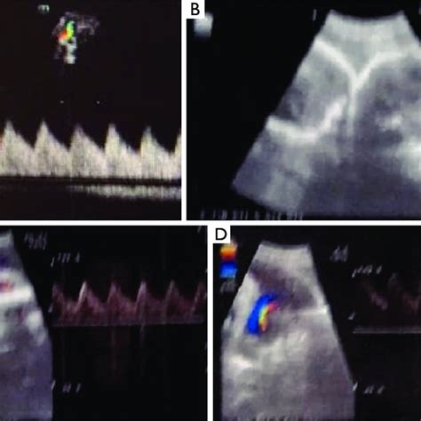 Ultrasound of 2 cases in the third trimester (A) On January 6 ...