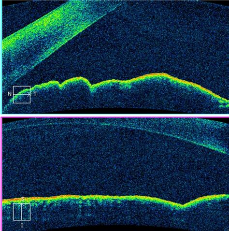 Figure From Giant Ocular Surface Squamous Neoplasia Wrapping Almost