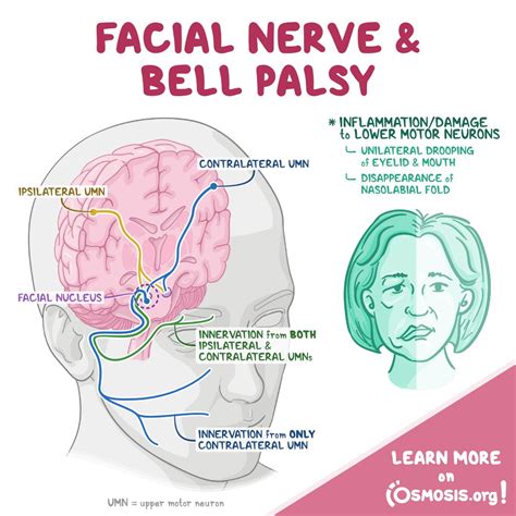 Facial Nerve Palsy Diagram