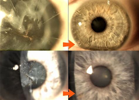 Corneal Scar Treatment