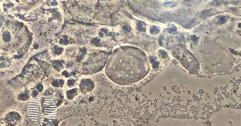 Aerobic vaginitis image