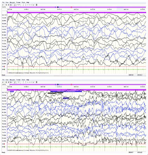 And 4 Case 2 Interictal EEG Showing Generalized Runs Of Polymorphic