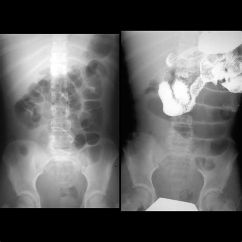SmallBowelObstruction01CAP24FromAdhesionsAtAdmissionAXRUGI1DayLater