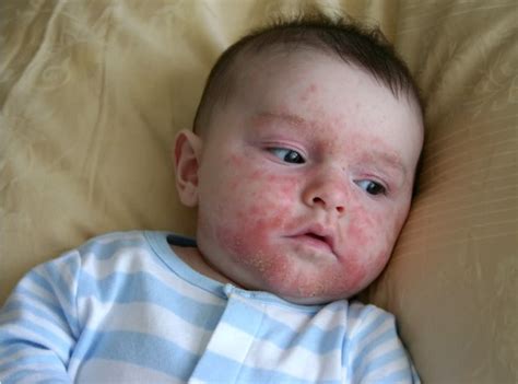 What Is Infantigo Impetigo Images Treatment Causes Symptoms