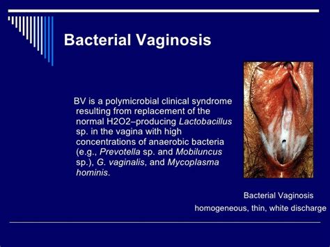 19infection Of Vaginal