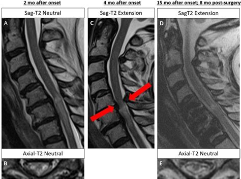 Mri With Neck Extension To Diagnose Cervical Spondylotic Myelopathy