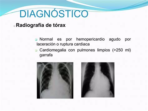 Taponamiento Cardiaco Ppt