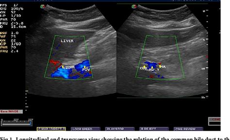 Figure 1 From Sonographic Measurement Of Normal Common Bile Duct Diameter And Associated Factors