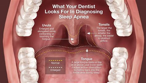 How An Oral Appliance Can Help Your Sleep Apnea