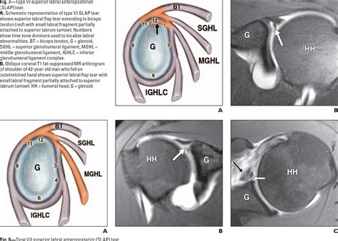 Figure From Superior Labral Anteroposterior Lesions Of The Shoulder