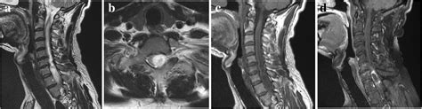 Mr Imaging Features Of Spinal Pilocytic Astrocytoma Bmc Medical