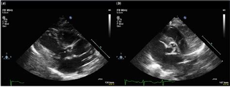 Parasternal long-axis view (a) and parasternal short axis view (b ...