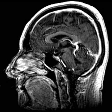 Sagittal Mri Demonstrating An Enlarged Occipital Dural Venous Sinus Download Scientific