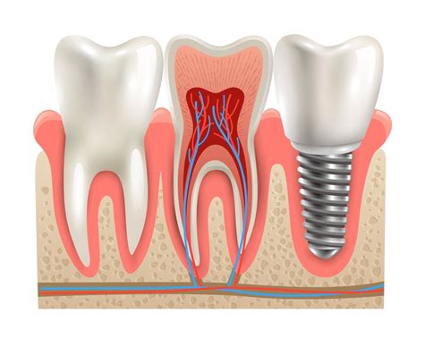 How Do Dental Implants Preserve Bone Mass Empire Dental