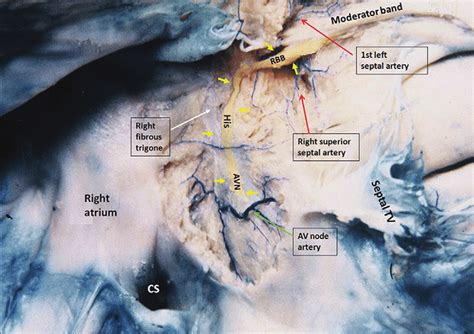 Cadaveric Image Of The View From The Medial Wall Of The Right Atrium