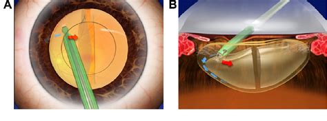 Figure 1 From Irrigation Dynamic Pressure Assisted Hydrodissection