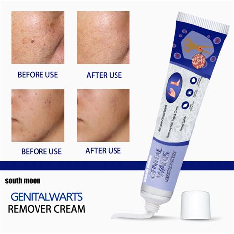 South Moon Genital Warts Remover Cream Biji Kolestrol Mole Removal Wart