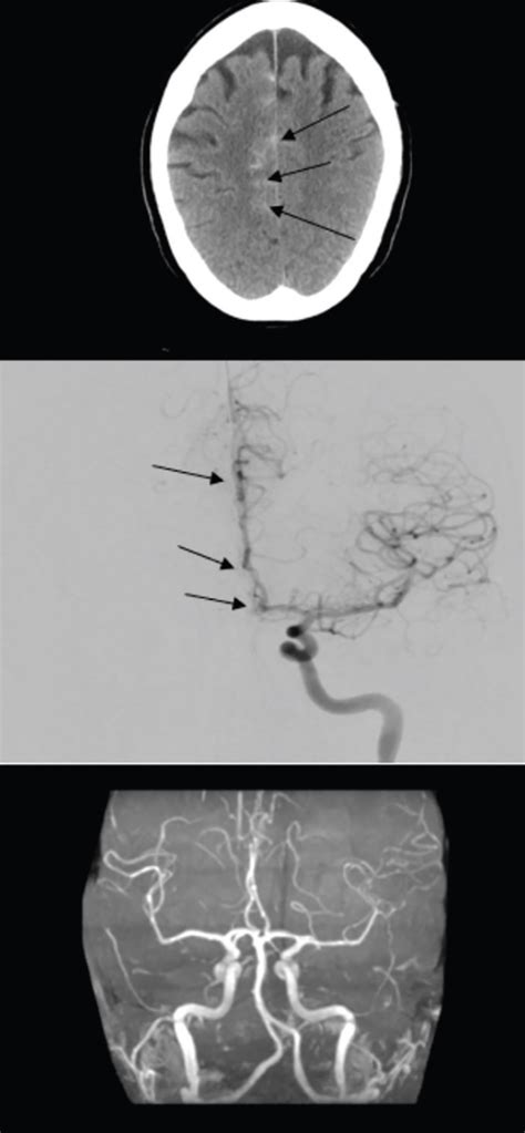 Headache Horizons Reversible Cerebral Vasoconstriction Syndrome Presentation Diagnosis And