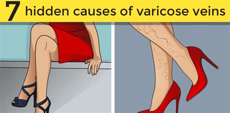 What Are The Causes Of Varicose Veins