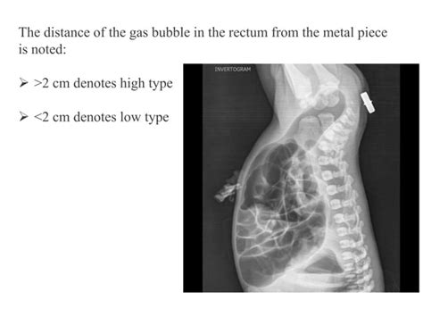 Abdominal Distension In Neonates Part 2pptx