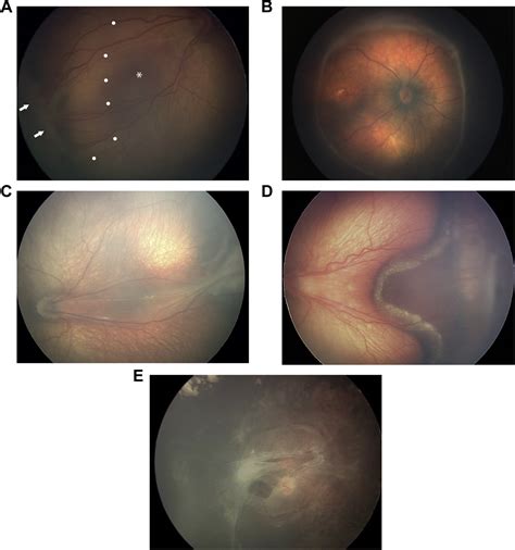 International Classification Of Retinopathy Of Prematurity Third Edition Ophthalmology