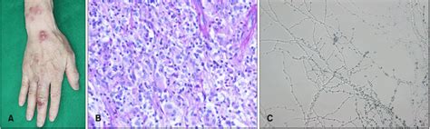 A Skin Lesion On The Dorsum Of Right Hand And Forearm With Multiple Download Scientific