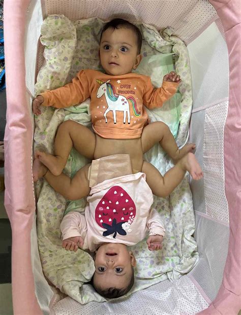 Rare Conjoined Twins Successfully Separated After 18 Hour Surgery