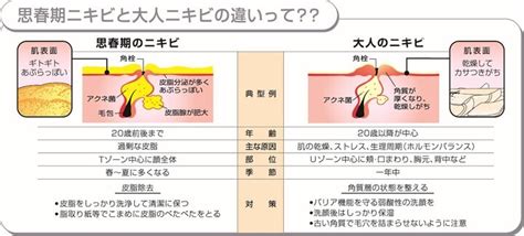 「思春期ニキビ」と「大人ニキビ」の違いを8割以上が知らない！親と子世代での思春期ニキビの意識の差も！“ニキビつぶす派”親世代4割、子世代1割