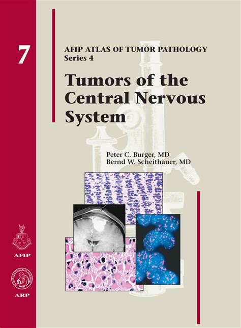 Central Nervous System Tumors 裁断済み 健康医学