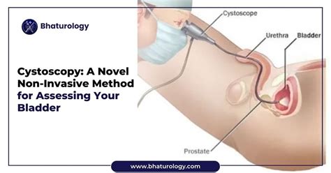 Cystoscopy A Novel Non Invasive Method For Assessing Your Bladder